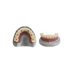 Full-Arch Implant Prosthesis with Titanium understructure